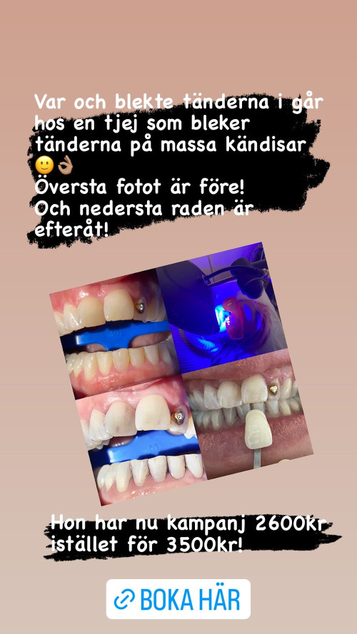 Tandblekning