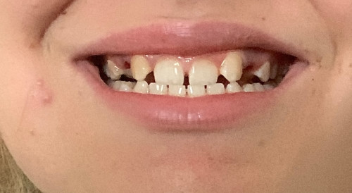 Två tänder utdragna 
